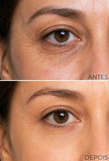 ÁREA DOS OLHOS – BOTOX SEM AGULHA